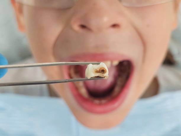 Best Emergency Wisdom Teeth Removal in Collierville, TN