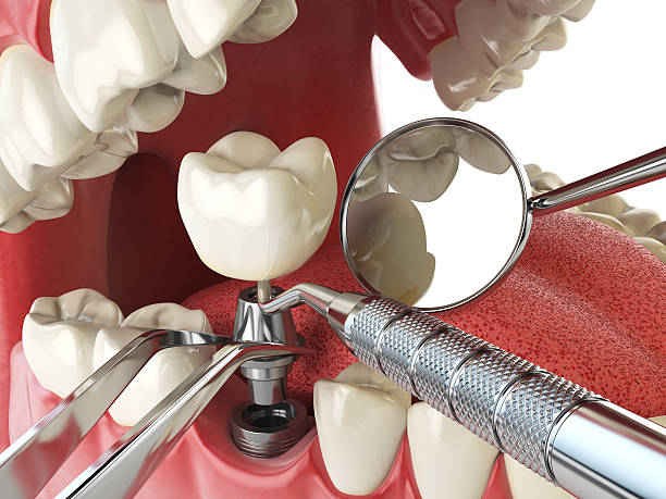 Best Emergency Tooth Extraction in Collierville, TN